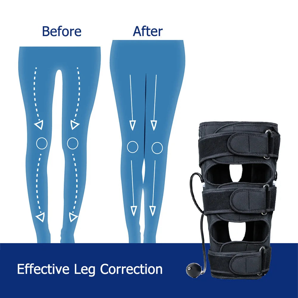 O/X Type Leg Correction Support Band Effective Bowed Knee Valgum Straightening Belt Posture Corrector For Adults Kids